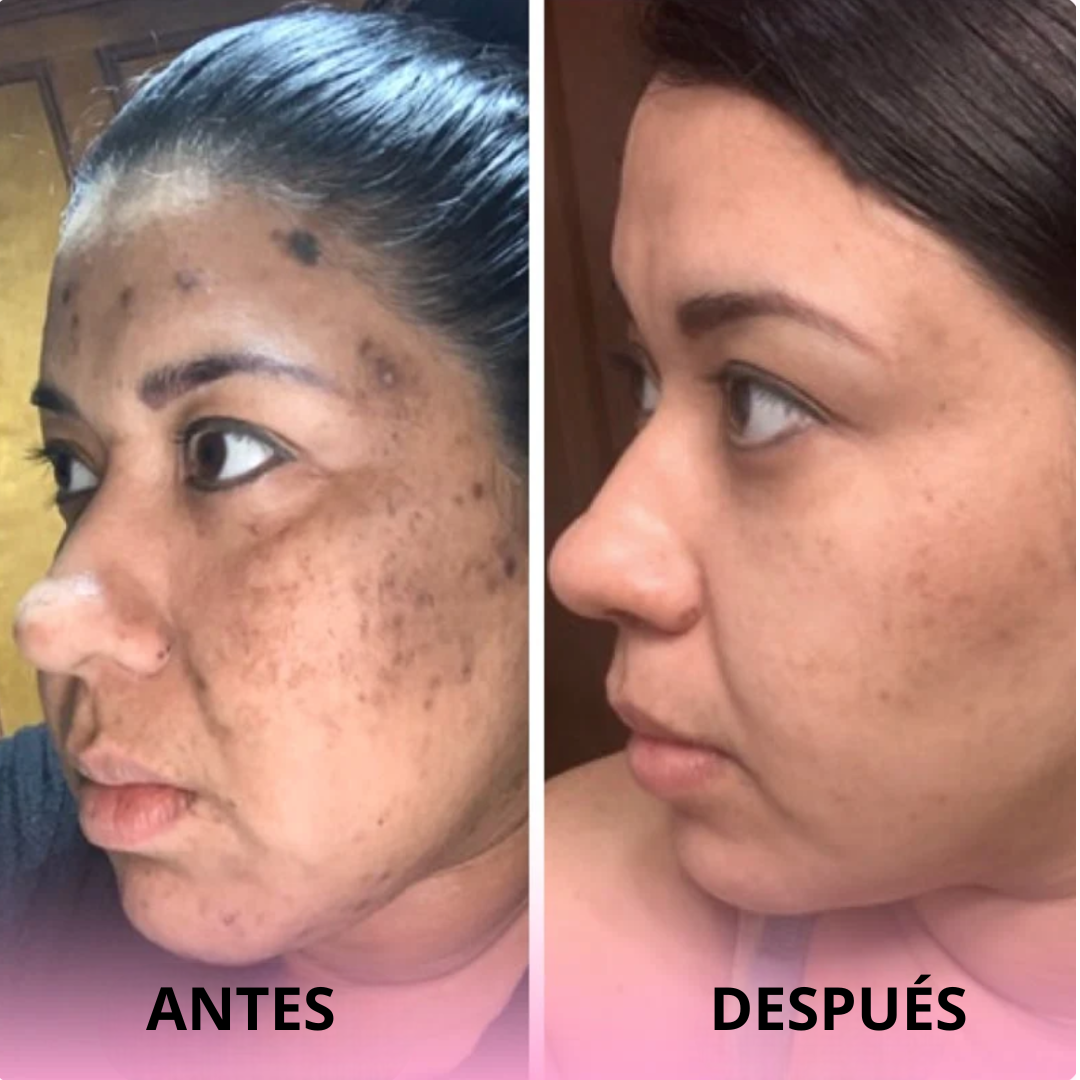 Algodones de Cúrcuma y Ácido Kójico