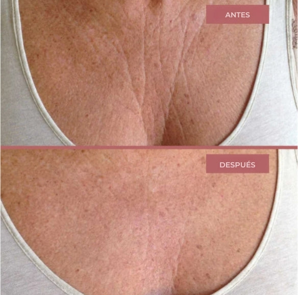 Parches de Biocolágeno para el Pecho