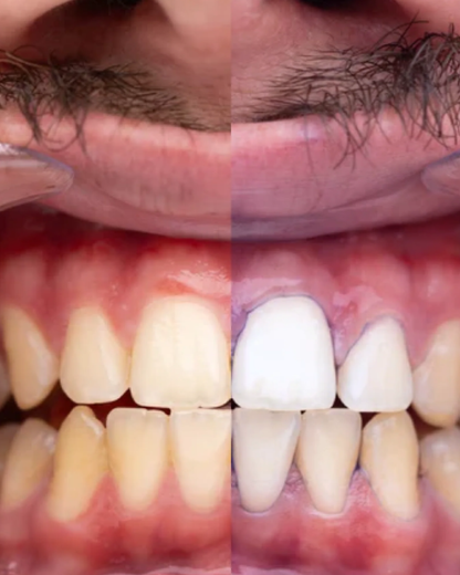 Blanqueador V34 Glumi